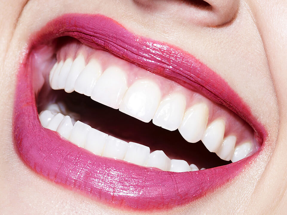 Esthetique dentaire Paris - Sourire