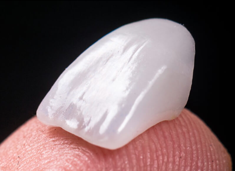 Facette dentaire Paris 75001