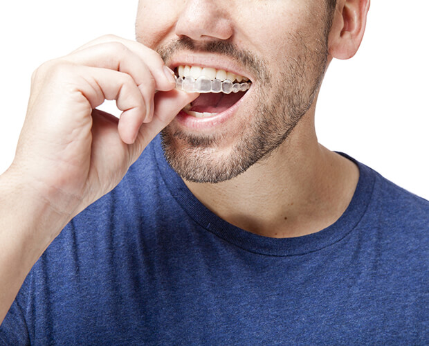 Orthodontie invisible Paris 1 - Sourire